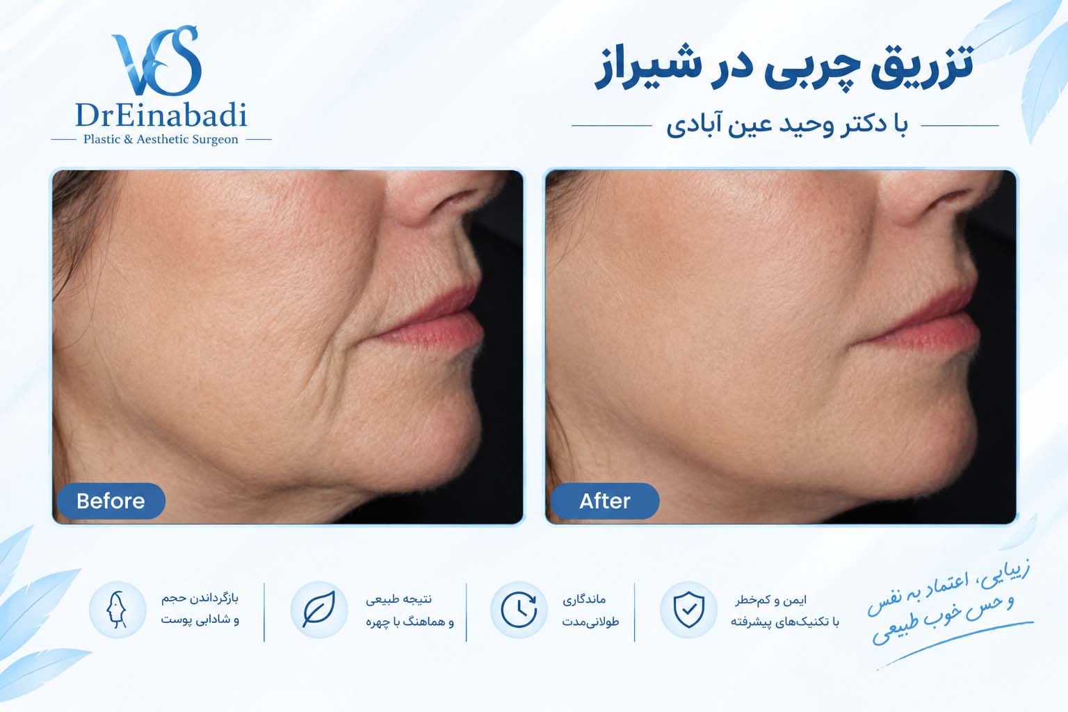 نمونه کار تزریق چربی دکتر عین آبادی